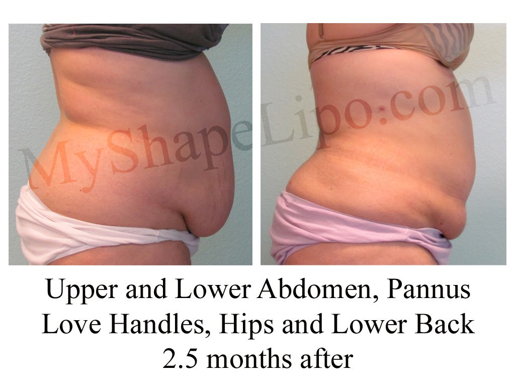 Liposuction Vs Tummy Tuck Top 5 Reasons Liposuction Is The Best Choice For A Trimmer Waist This